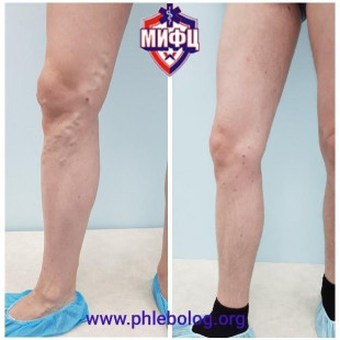 Лечение мужского варикоза на правой ноге