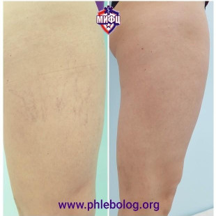 Результат удаления сосудистых звзедочек