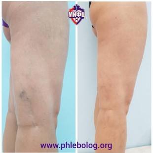 Склеротерапия сосудистых звездочек