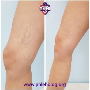 Удаление звездочек на внутренней поверхности бедра