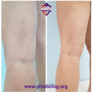 Прекрасный результат микросклеротерапии сосудистых звездочек на ногах