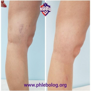 Замечательный результат лечения сосудистых звездочек