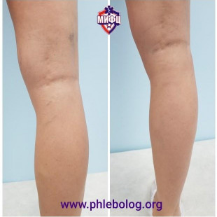 Результат удаления ретикулярных вен на голени