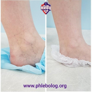 Результат лечения сосудистых звездочек в области лодыжки