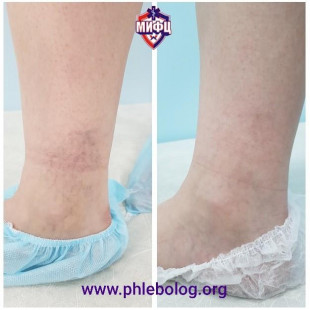 Результат удаления телеангиэктазов на правой голени