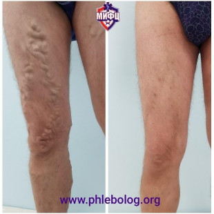 Лечение варикоза у мужчин