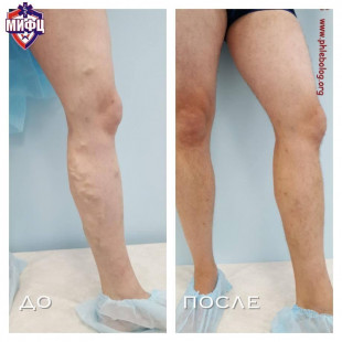 Лечение варикоза методом минифлебэктомии по Варади