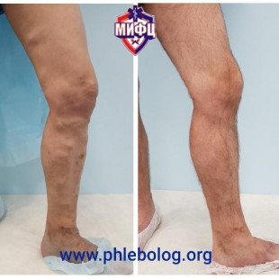 Результат лечения варикоза лазером с новой длиной волны 1940 Нм
