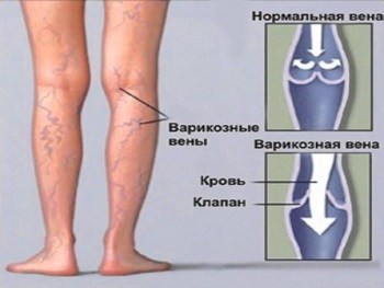 sindromul varicose foot nelinitit