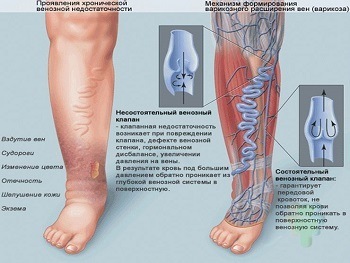 thromboflebits varicoza foot tratament