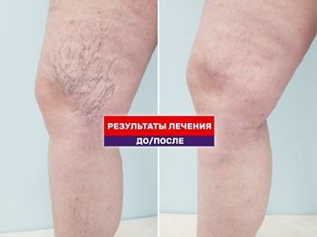 Год после склеротерапии! Честный видео разбор в рубрике 
