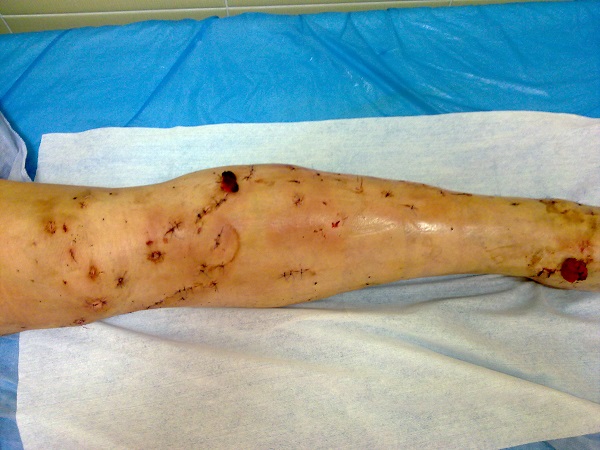 Вид ноги после классической операции на венах