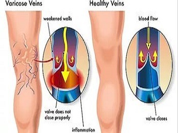 Как вылечить варикоз ног в клинике thumbnail